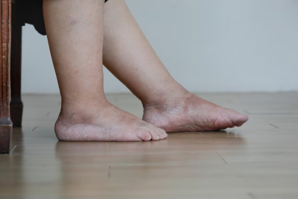 Kako se leči dijabetično stopalo